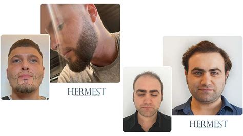 hermest istanbul|haartransplantation istanbul.